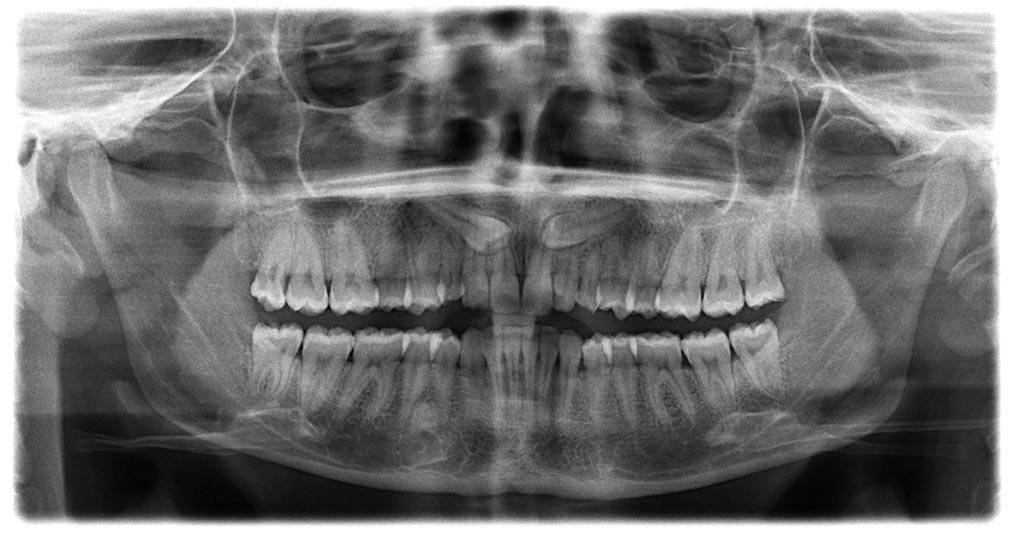 Radiografia para Fenestraciones para dientes incluidos