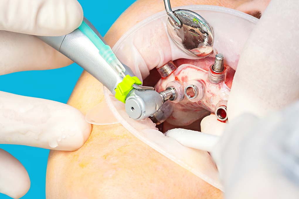 Cirugía guiada de un implante dental