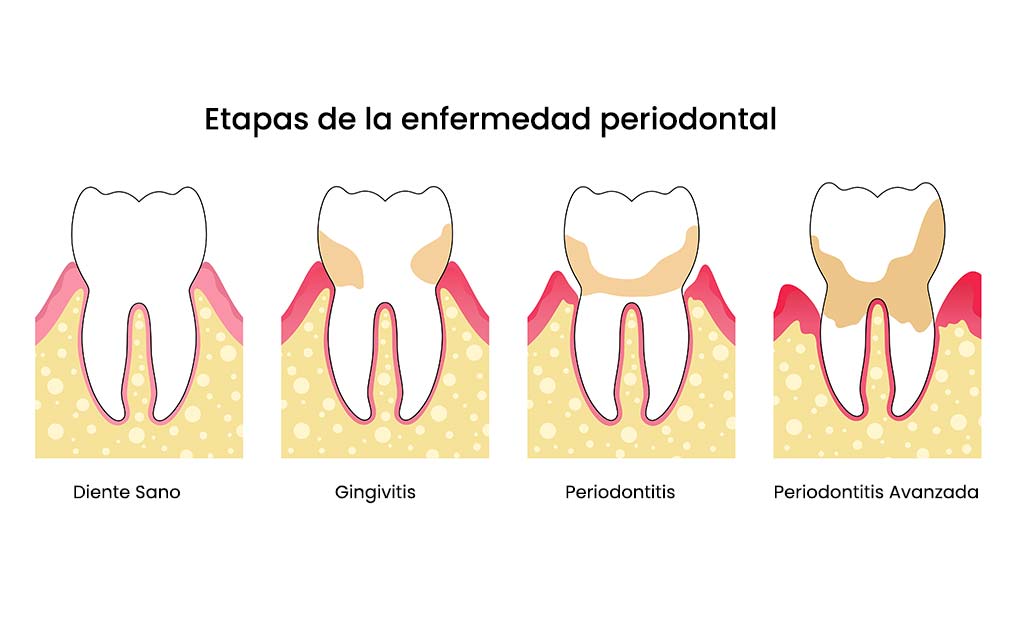 Etapas de la enfermedad periodontal